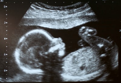 Ultrasound 2D image using 85 db pulses. Ultrasound 2D image using 85 db pulses.